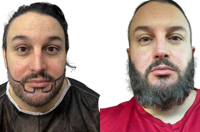 Patchy Beard Growth: How to Handle It