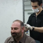Sapphire FUE vs Traditional FUE_UniquEra_Clinic