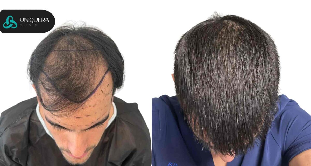 What Results Can You Expect from a Successful Hair Transplant Surgery?