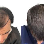 Hair Transplant Surgery_UniquEra_Clinic