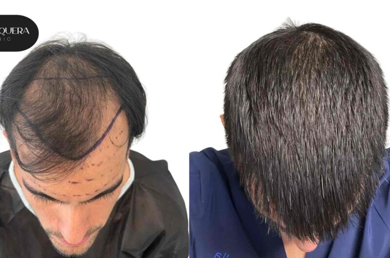 What Results Can You Expect from a Successful Hair Transplant Surgery?