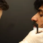 Beard Transplant in Turkey_UniquEra_Clinic