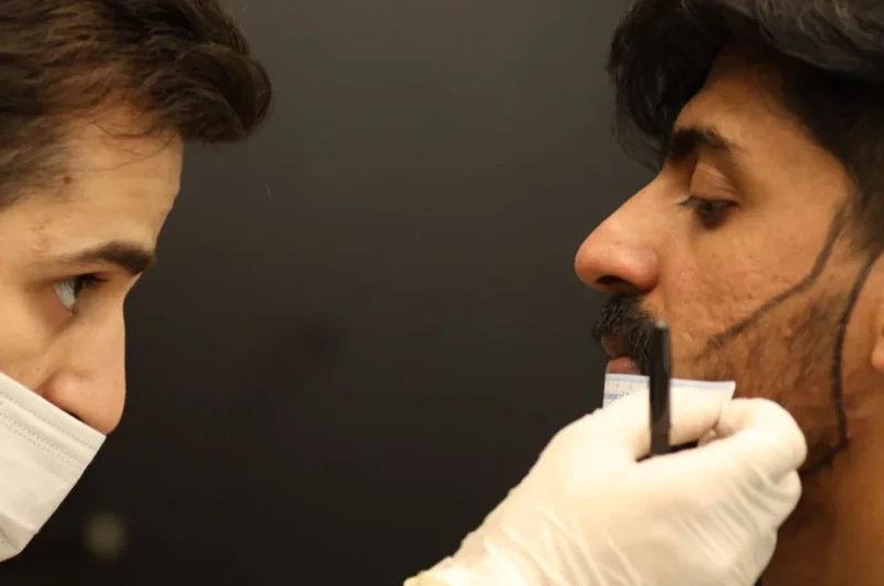 Beard Transplant in Turkey: Everything a Patient Needs to Know