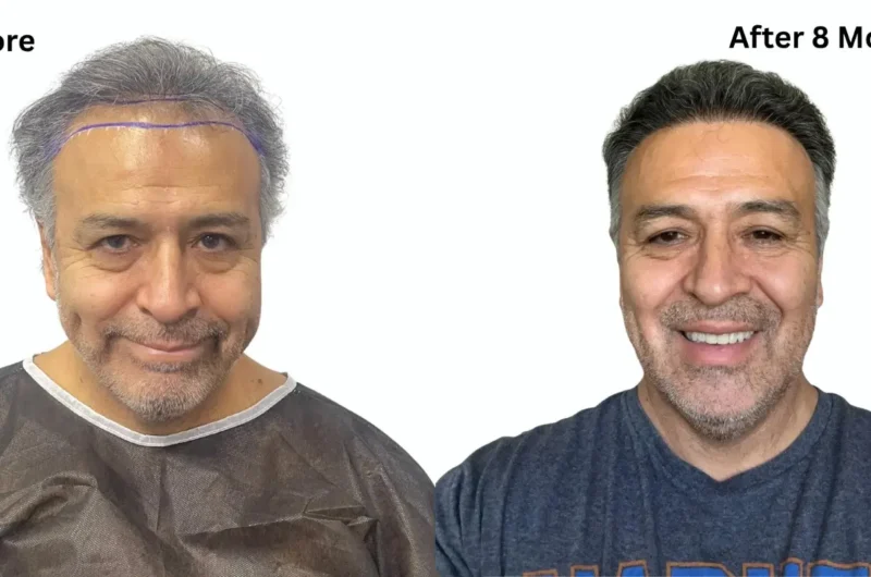 Do Hair Transplants Work? Success Rates & Results