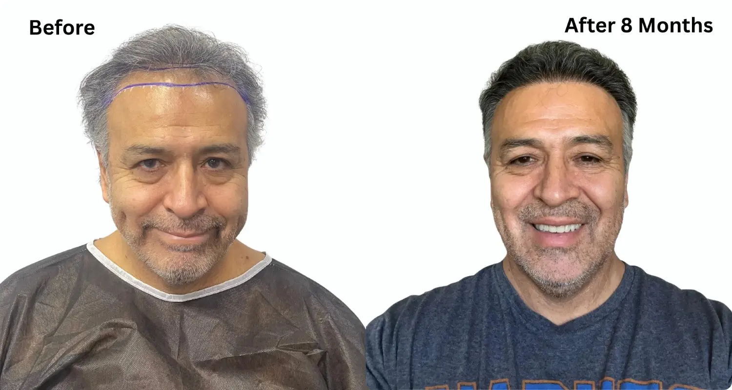 Do Hair Transplants Work? Success Rates & Results
