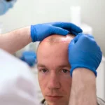 Fix Failed Hair Transplant