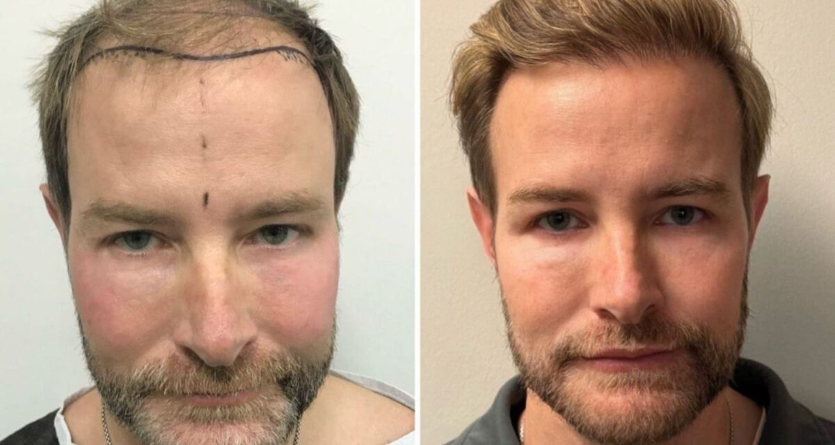 Hair Transplant Right After: A Complete Guide to Your Hair Recovery