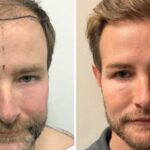 Hair Transplant Right After_UniquEra_Clinic