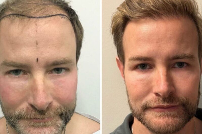 Hair Transplant Right After: A Complete Guide to Your Hair Recovery