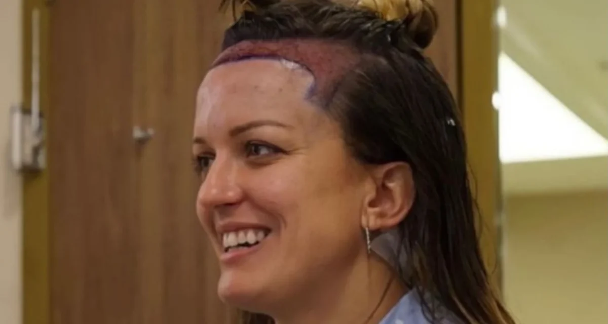 Hair Transplant for Women: Complete Procedure, Cost, and Recovery Guide