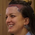 Hair Transplant for Women