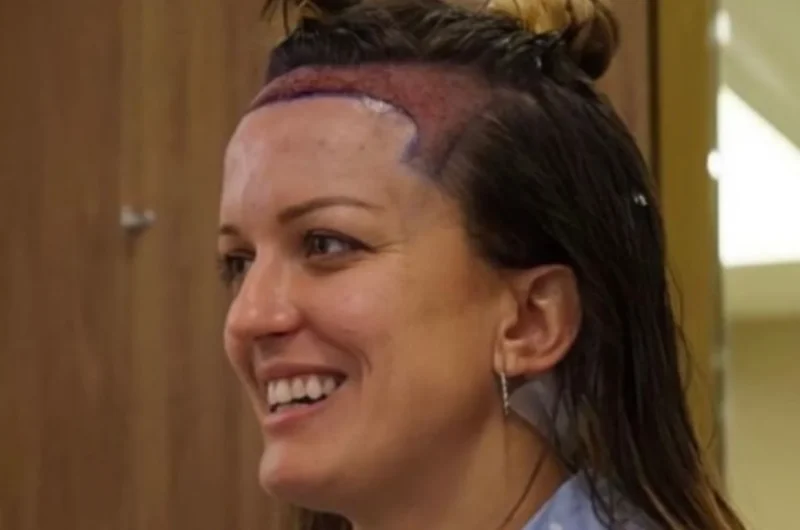 Hair Transplant for Women: Complete Procedure, Cost, and Recovery Guide