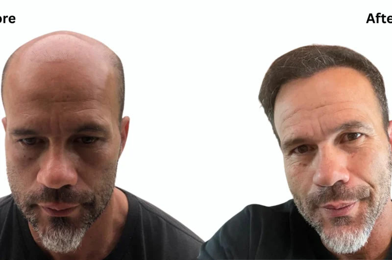 Is a 5000 Graft Hair Transplant Enough for Your Hair? Complete Guide to Cost, Coverage & Timeline