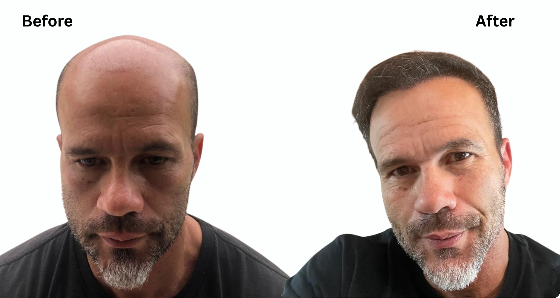 Is a 5000 Graft Hair Transplant Enough for Your Hair? Complete Guide to Cost, Coverage & Timeline