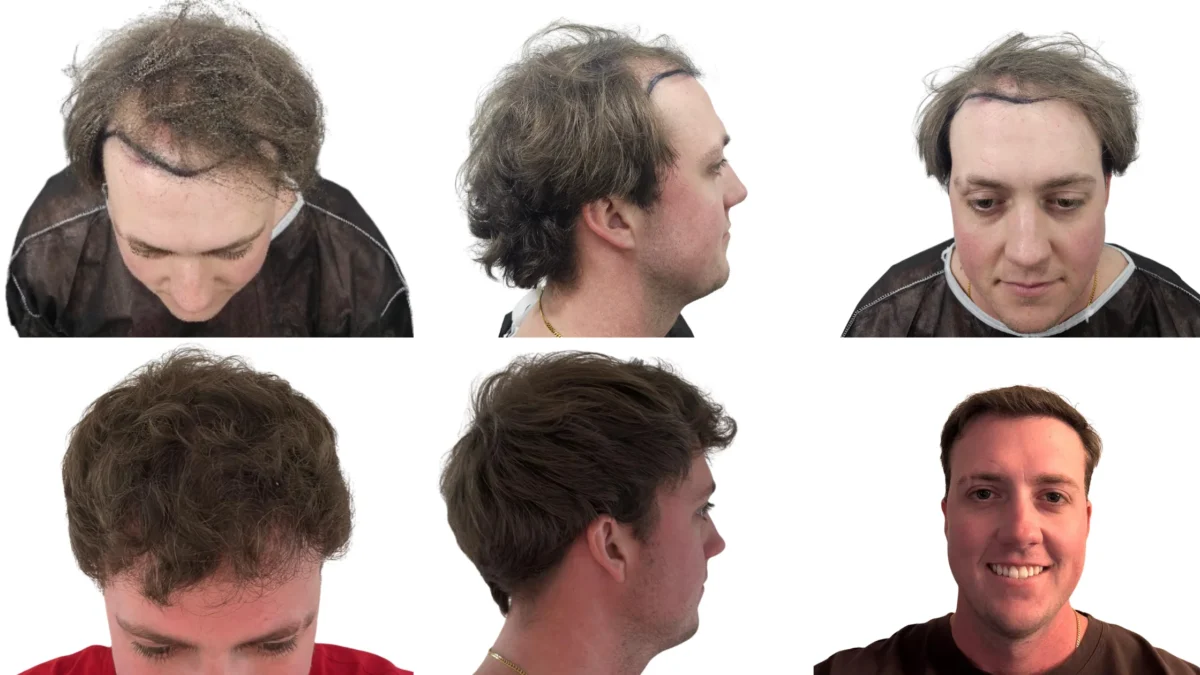 Is a Hair Transplant Permanent? What Hair Transplant Experts Say