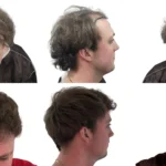 Is a Hair Transplant Permanent_UniquEra_Clinic