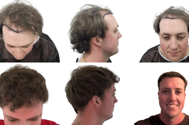 Is a Hair Transplant Permanent? What Hair Transplant Experts Say