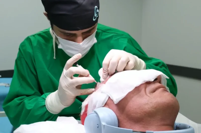 Step-by-Step Process of a DHI Hair Transplant in Turkey: A Complete Guide