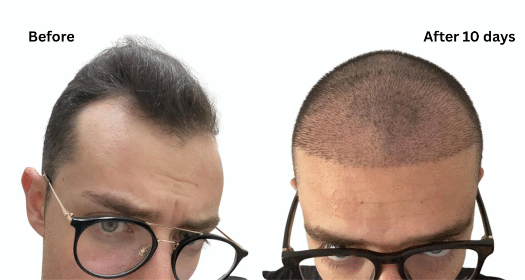 hair transplant before and after_uniquEra_Clinic
