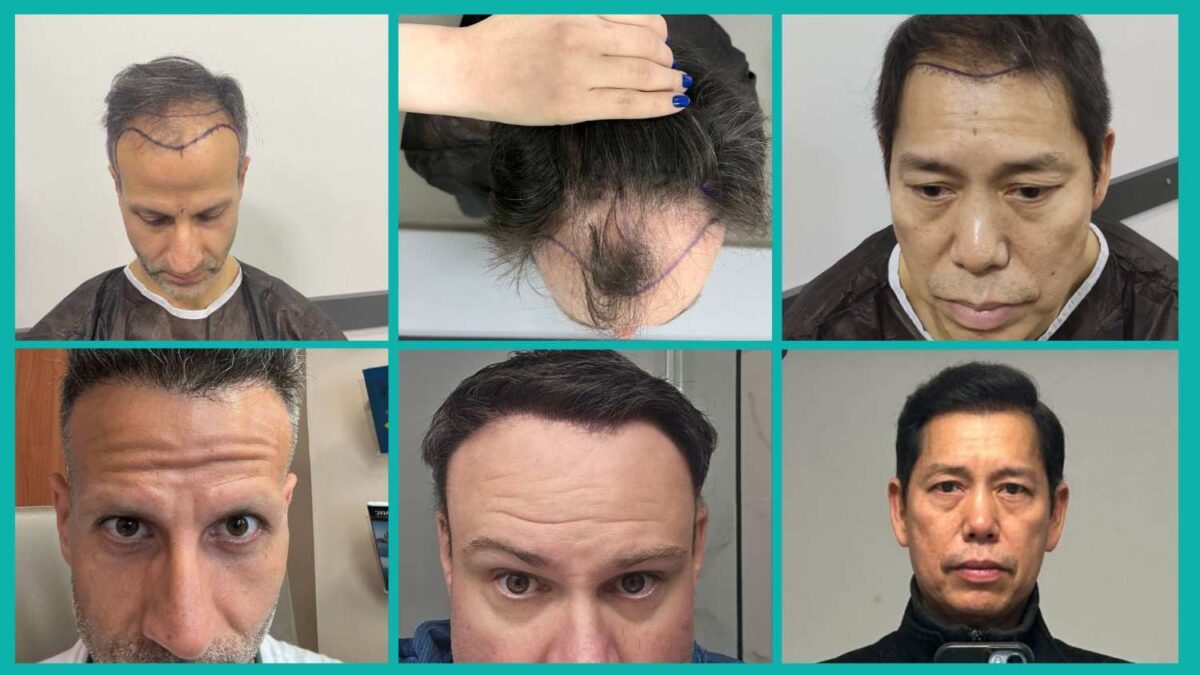 Best Hair Loss Treatment For Receding Hairline For Both Men & Women