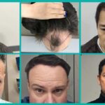 Best Hair Loss Treatment for Receding Hairline