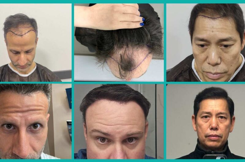 Best Hair Loss Treatment For Receding Hairline For Both Men & Women