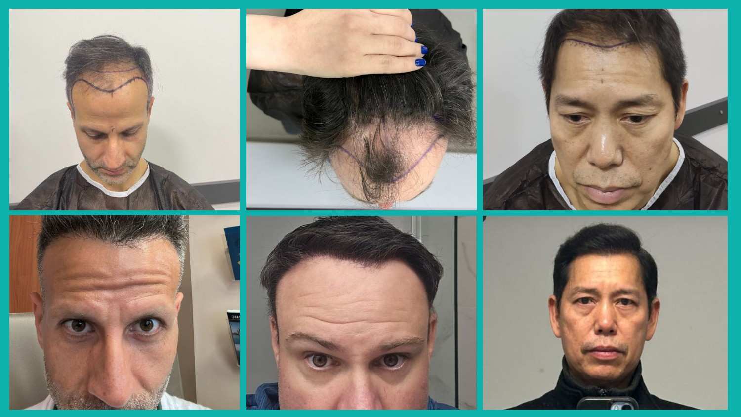 Best Hair Loss Treatment For Receding Hairline For Both Men & Women