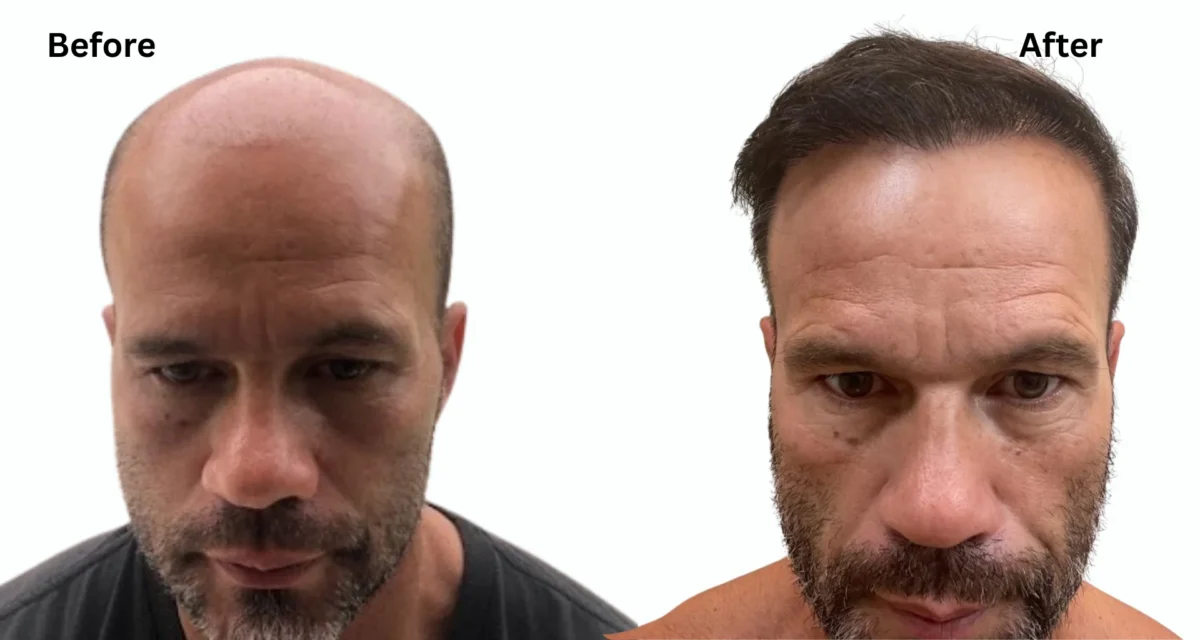 Can You Get a Hair Transplant If You Are Completely Bald?