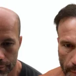 Can You Get a Hair Transplant If Completely Bald_uniquEra_clinic