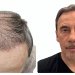 Diffuse Thinning Hair
