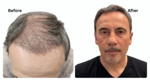 Diffuse Thinning Hair