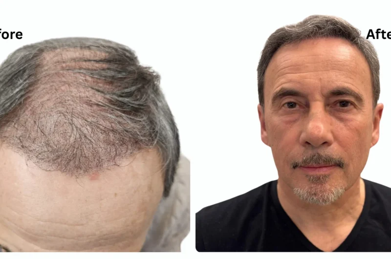 Diffuse Thinning Hair Treatment in Turkey: Cost, Steps, and Best Techniques