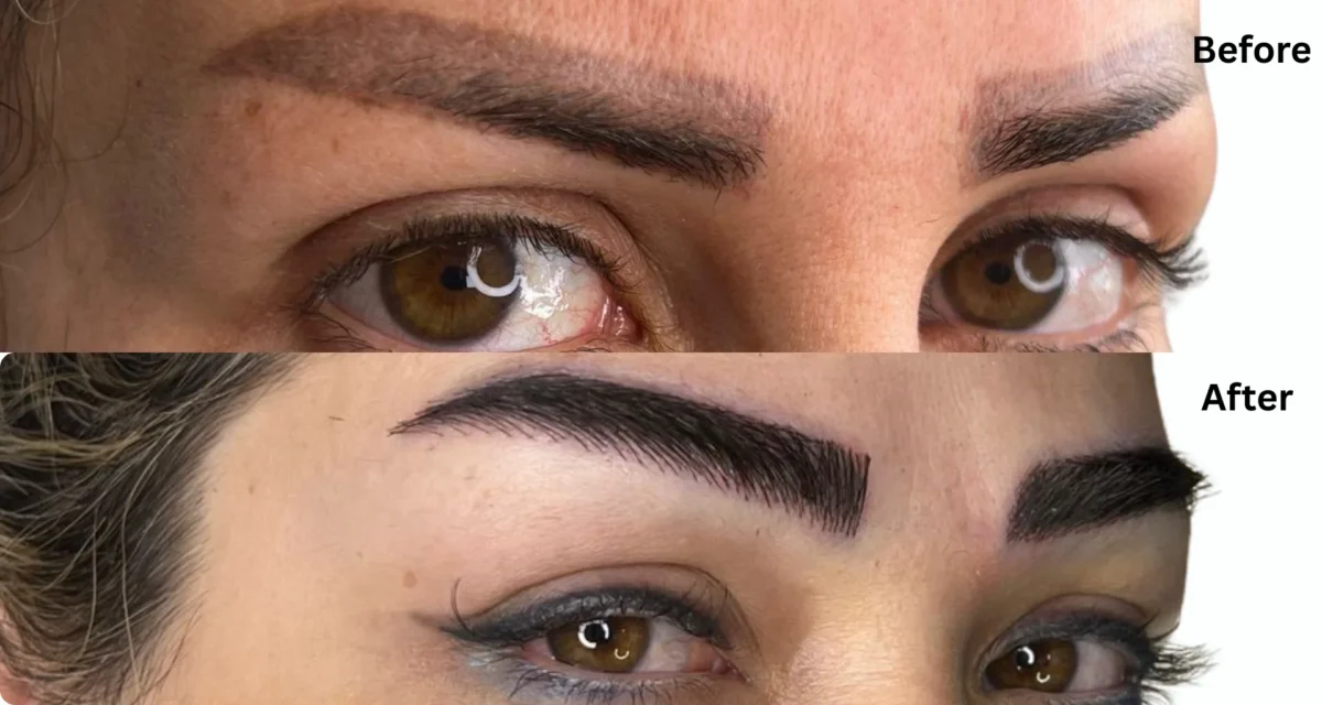 Eyebrow Transplant: Complete Cost, Procedure, and Recovery Guide