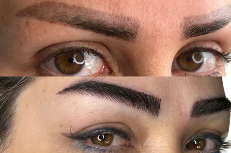 Eyebrow Transplant: Complete Cost, Procedure, and Recovery Guide