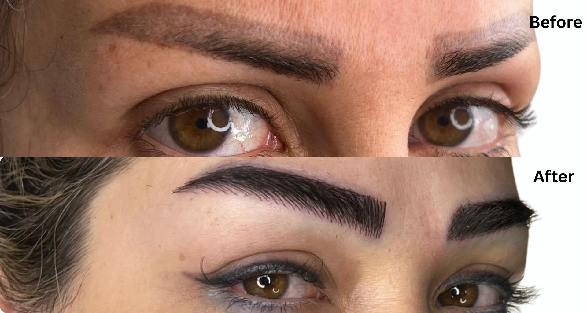 Eyebrow Transplant: Complete Cost, Procedure, and Recovery Guide