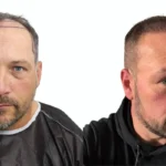 Is Hair Transplant Worth It_uniquEra_clinic