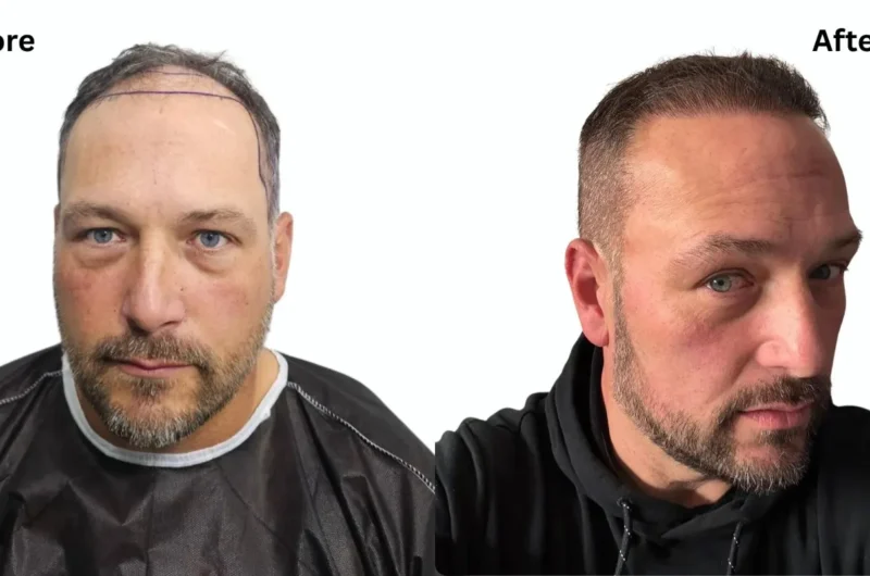 Is Hair Transplant Worth It? Pros and Cons Unveiled