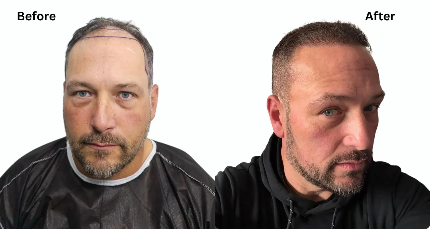 Is Hair Transplant Worth It? Pros and Cons Unveiled