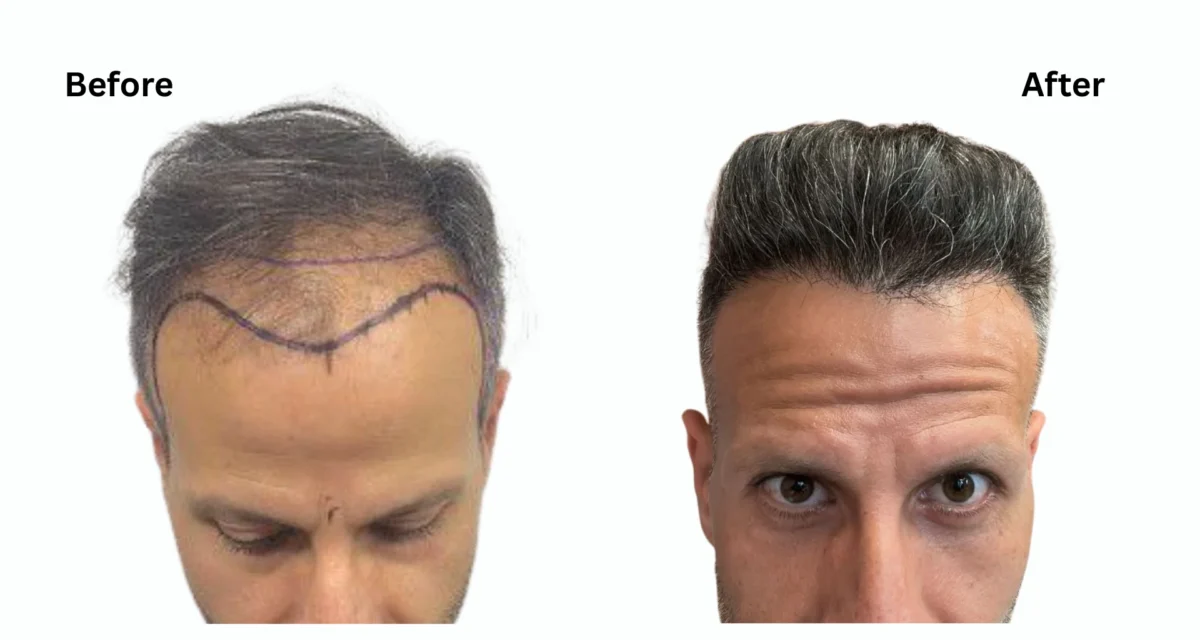 Sapphire FUE Hair Transplant: Everything You Need to Know