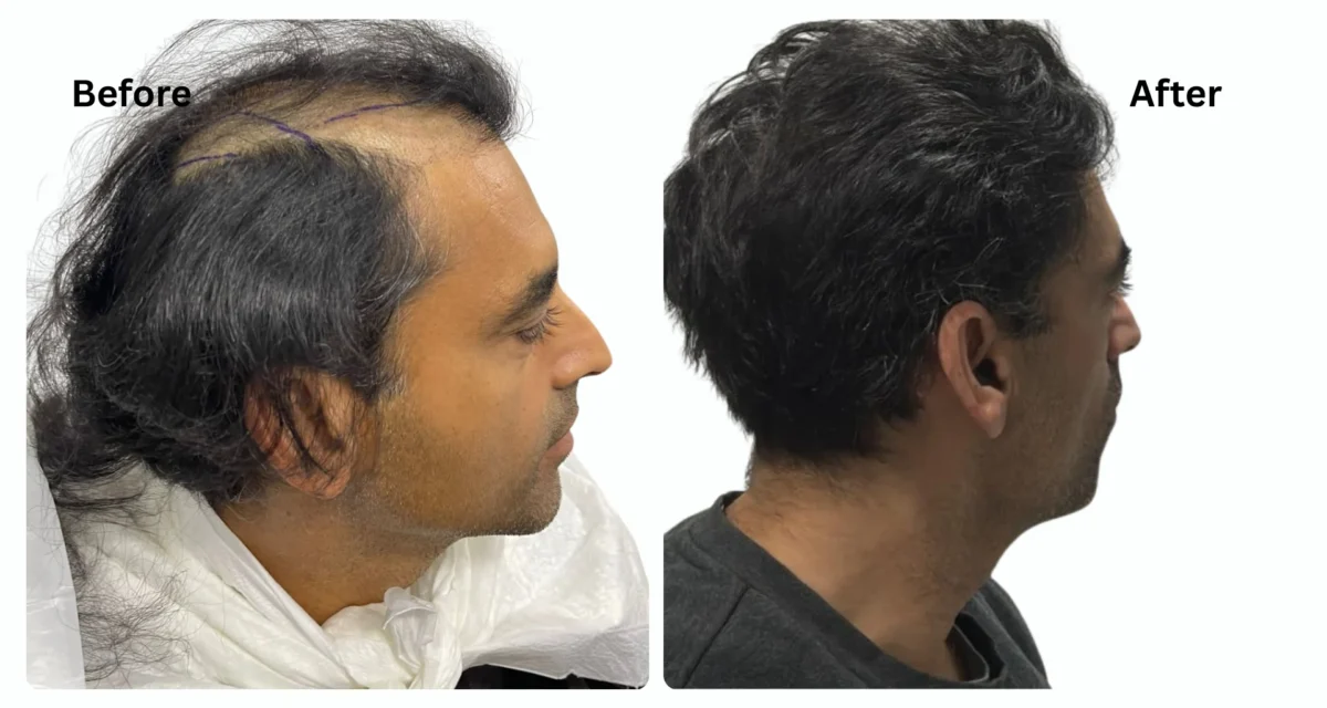 Sapphire Fue Hair Transplant Costs in Turkey: and What You Should Really Know