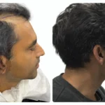 Sapphire Hair Transplant in Turkey Costs Quality and What You Should Really Know