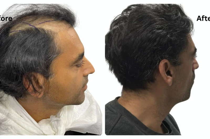 Sapphire Fue Hair Transplant Costs in Turkey: and What You Should Really Know