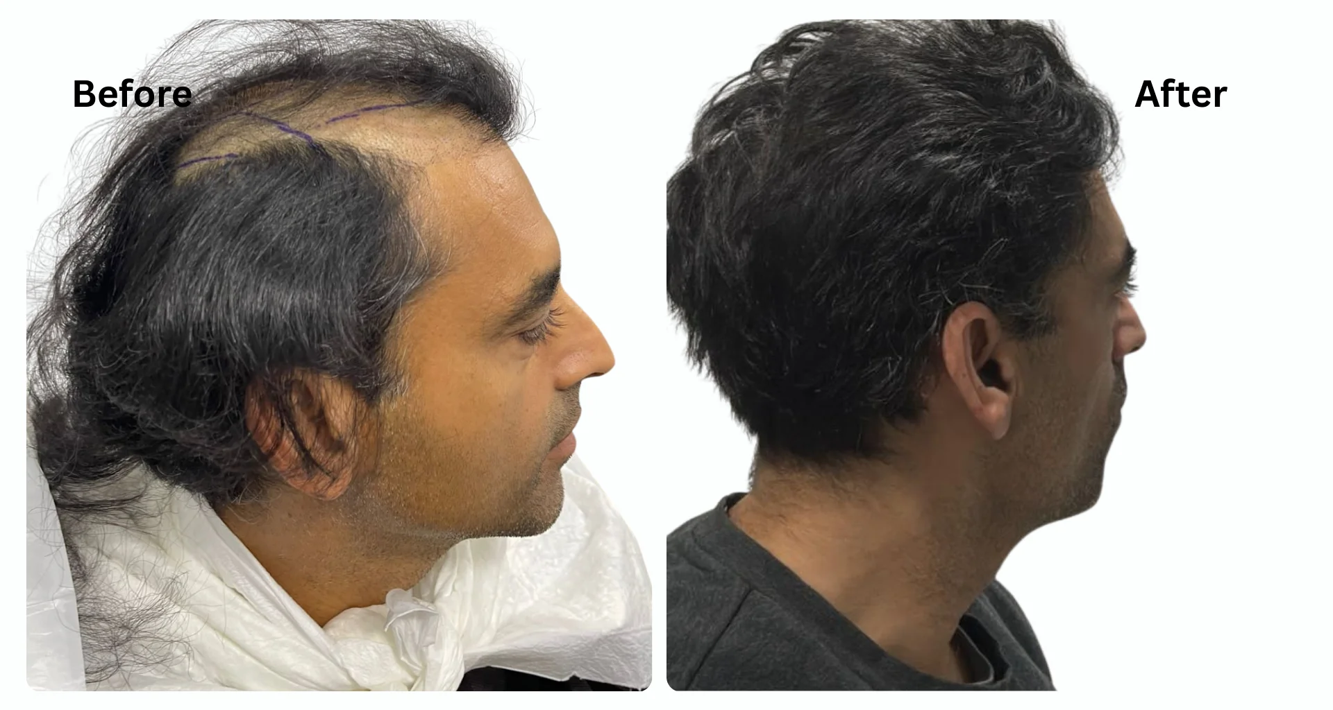 Sapphire Fue Hair Transplant Costs in Turkey: and What You Should Really Know