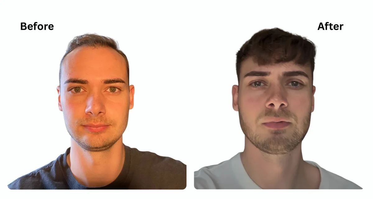 Top 10 Questions to Ask Your Hair Transplant Expert in Turkey Before Surgery