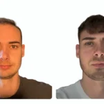 Hair Transplant expert_UniquEra_Clinic