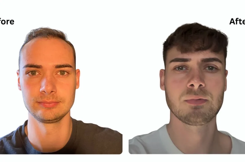 Top 10 Questions to Ask Your Hair Transplant Expert in Turkey Before Surgery