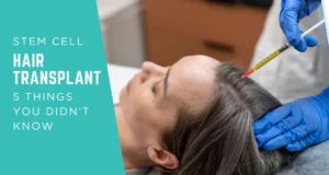 stem cell hair transplant