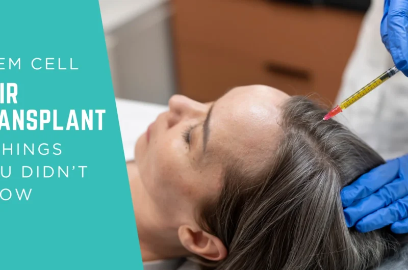 5 Things You Didn’t Know About Stem Cell Hair Transplant