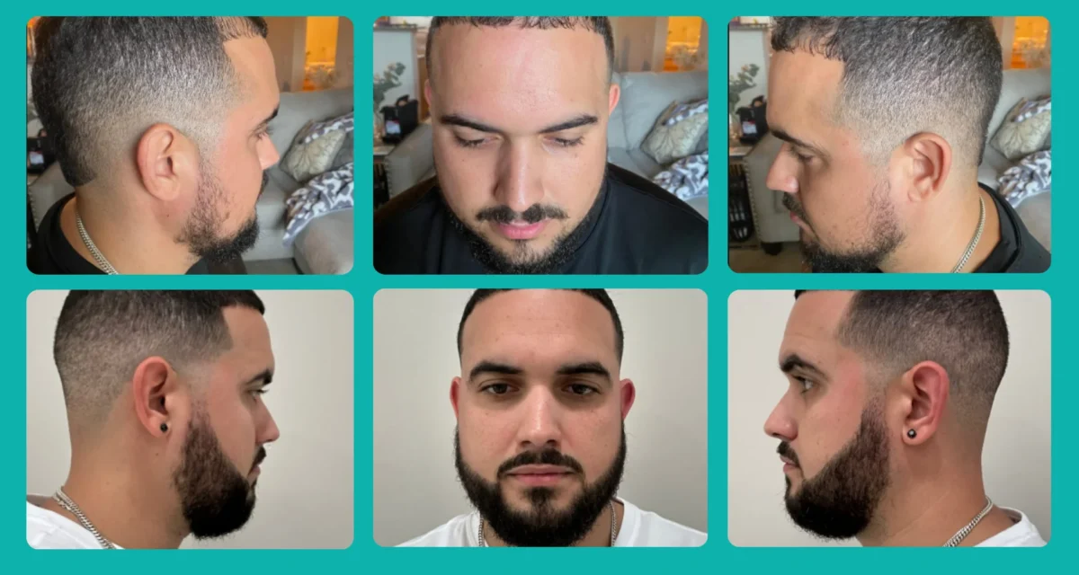 A Complete Guide to Beard Transplant in Turkey: Cost, Techniques, and Real Results