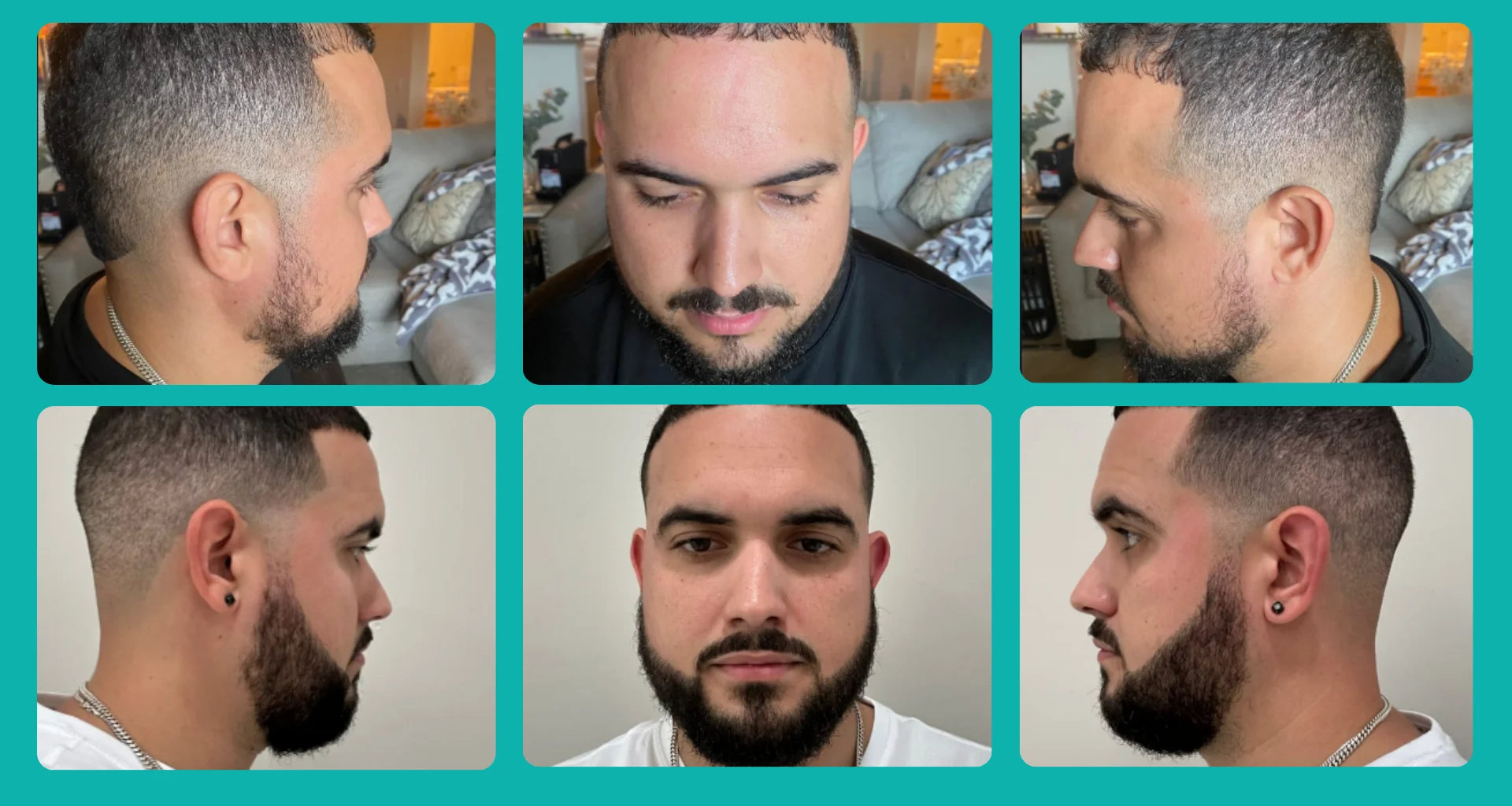 A Complete Guide to Beard Transplant in Turkey: Cost, Techniques, and Real Results